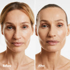 Skin Rejuvenation